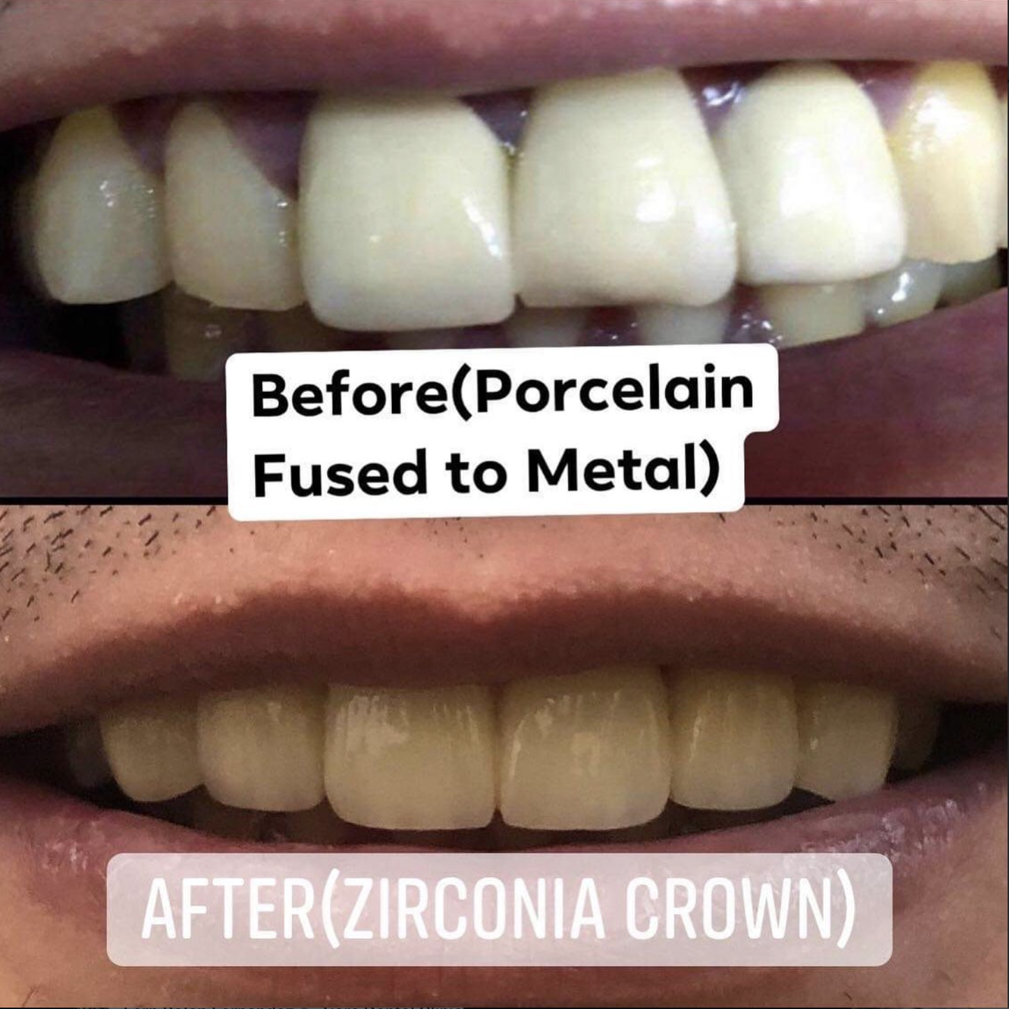 Before and after a zirconia crown at Tiara Dental Clinic in Cubao, Quezon City, replacing an older porcelain-fused-to-metal crown