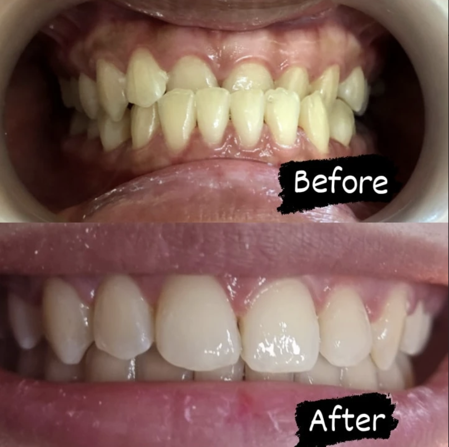 Before and after braces at Tiara Dental Clinic in Cubao, Quezon City, with crowded upper and lower teeth brought into alignment