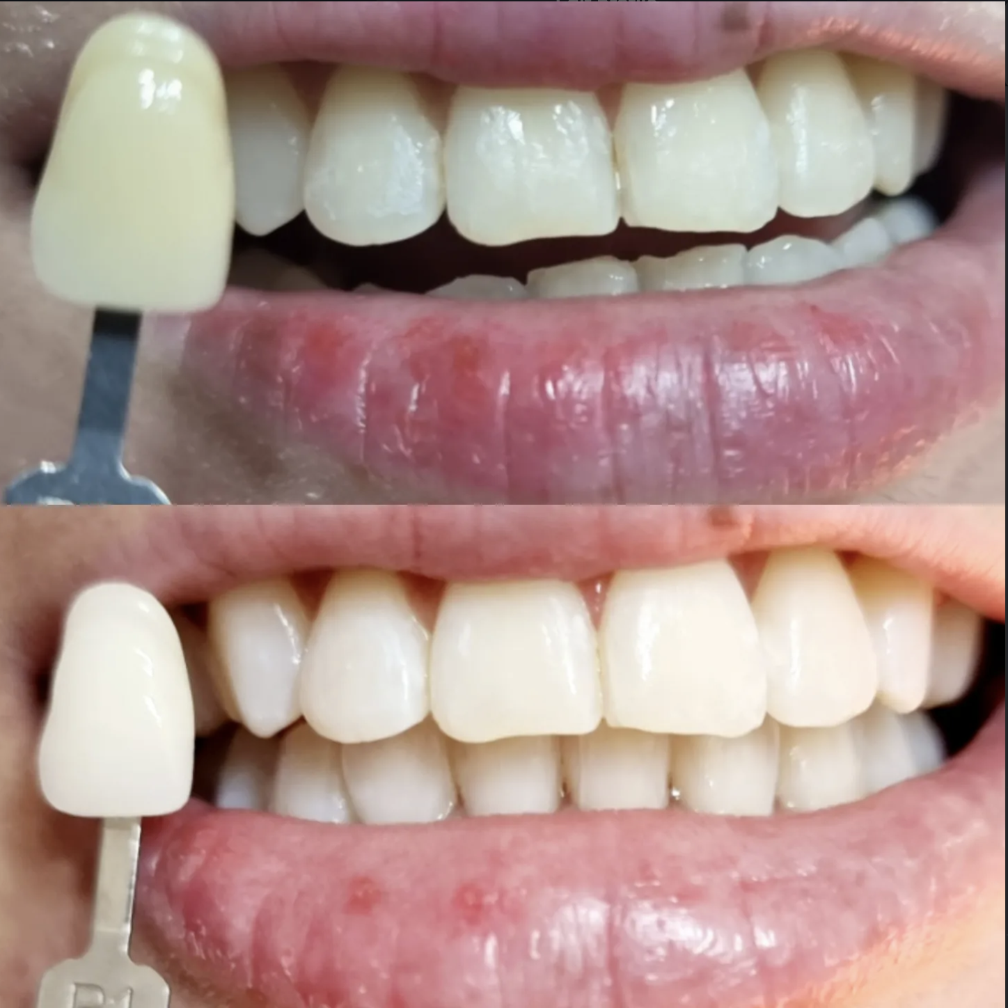 Before and after professional teeth whitening at Tiara Dental Clinic in Quezon City, checked against a shade guide