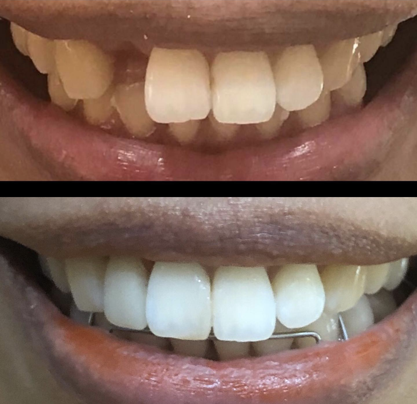 Before and after veneer treatment at Tiara Dental Clinic in Cubao, Quezon City, showing the upper teeth restored to an even, natural shade