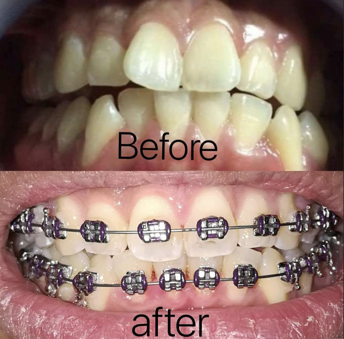 A complex orthodontic case at Tiara Dental Clinic in Cubao, Quezon City, shown before treatment and again with braces fitted and the bite correcting